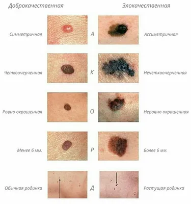 ТИПИЧНЫЕ ВНЕШНИЕ ПРОЯВЛЕНИЯ РАКА КОЖИ И МЕЛАНОМЫ | Онкология понятным  языком. Доктор Вячеслав Лисовой | Дзен