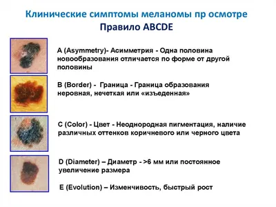 Онко Вики — Формы меланомы