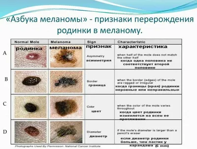 Меланома кожи. Как максимально снизить риски развития меланомы? | Городской  кожно-венерологический диспансер