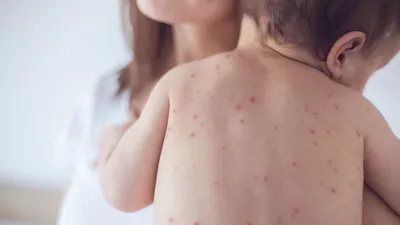 Лечение кори (Morbilli) в Киеве — Derma.ua