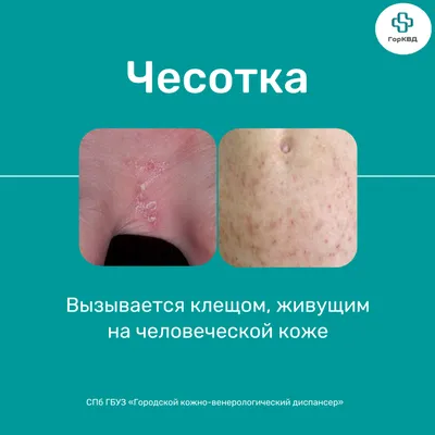 Грибковые заболевания кожи » Клиника косметологии и дерматологии «ACADEMY»  — лечение кожи и волос.