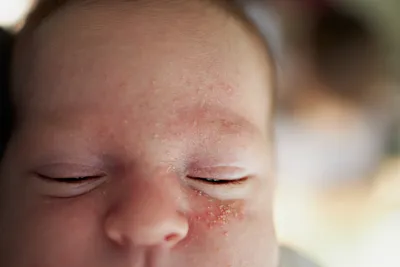 Everyday Clinic | Помогаем каждый день 👌🏼 on Instagram: \"Акне  новорожденных — это распространенное транзисторное состояние кожи  новорожденного ребенка, которое не является заболеванием и проходит  самостоятельно. ⠀ Высыпания наиболее часто появляются на