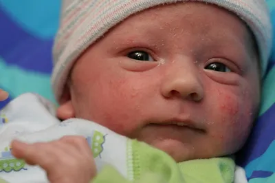 Аллергия или акне новорожденных? — 25 ответов | форум Babyblog