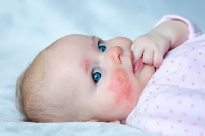 Акне новорожденных: что это и нужно ли лечить? | Babyblog.ru | Дзен