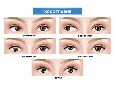 Передается ли косоглазие по наследству?