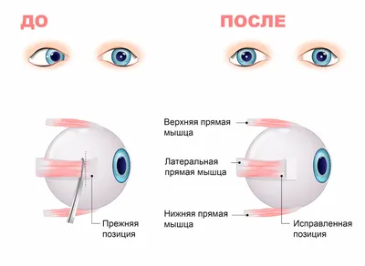 Лечение косоглазия у детей в Москве без операции