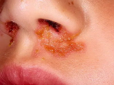 Что вызывает экзему кожи головы и как ее лечить - Все про аллергию