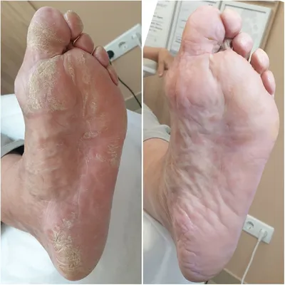 Конечные симптомы: зудящее пятно на ноге