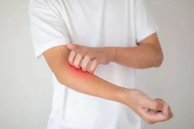 Экзема на лице, руках и ногах - причины и лечение атопического дерматита -  YouTube