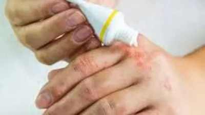 Антибактериальный крем дерматит экзема для наружного применения против зуда  и зуда для лечения проблем с кожей, крем от псориаза | AliExpress