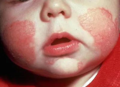 Контактный дерматит у детей - симптомы, причины, лечение в клинике «Будь  Здоров»
