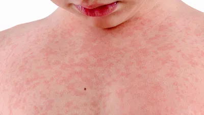 Аллергический дерматит - симптомы, признаки, виды и лечение у взрослых |  Универсум Клиник