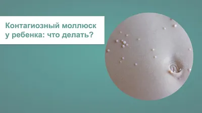 Удаление контагиозного (вирусного) моллюска - Клиника \"ЛИЦ\" СПб цена 500  руб.