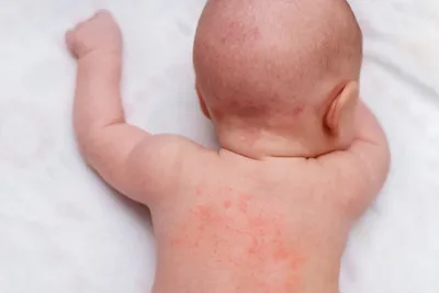 Сыпь у новорожденных: опасные и безопасные высыпания, милии, акне, меланоз  и дерматит
