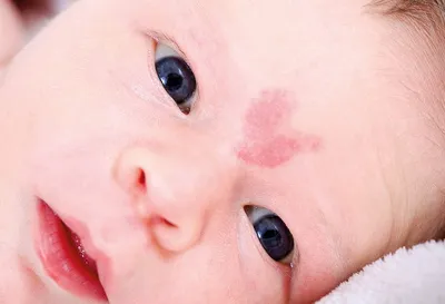 Молочница у новорожденных и детей до года: что значит белый налет во рту у  ребенка? Как лечить молочницу во рту у новорожденных | WOMAN