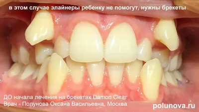 Стоматология «На Приморской» - Довольно часто к нам обращаются для удаления молочных  зубов. Связано это с тем, что многие родители считают их неважными. Ведь  после них всё равно вырастут коренные. Коренные можно