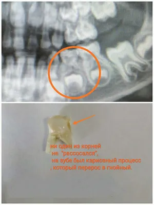 Молочные зубы у взрослых | Семейная стоматология