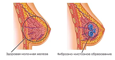 Молочная железа — все доброкачественные состояния у женщин и мужчин:  краткое описание патологий - Курбанова Зарема Вахаевна