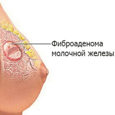Медцентр \"МедЛайн\" - Аденома молочной железы Аденома молочной железы –  форма мастопатии, наряду с фиброаденомой, фибромой, липомой и т.д. Эта  опухоль относится только к железистой ткани или паренхиме органа, характер  опухоли -