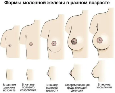 Киста молочных желез: симптомы, причины, диагностика, лечение