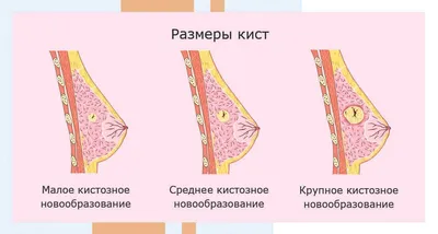 Киста молочной (грудной) железы - лечение кисты в груди у женщин