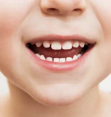 Кривые молочные зубы: причины и как исправить