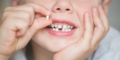 Кривые зубы у детей: причины роста неровных молочных зубов и методы  исправления кривизны