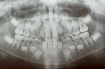 Лечат ли молочные зубы в стоматологических клиниках Минска