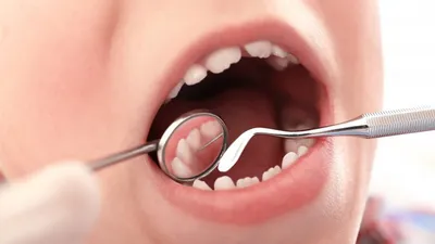 Всё про молочные зубы у детей: когда и как они выпадают? —  Стоматологическая клиника \"ЖЕМЧУГ\" г. Серов