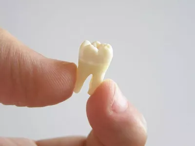 Коронки на молочные зубы | Стоматология \"Дентонекс\" - лечение, имплантация,  протезирование, отбеливание и гигиена зубов во Владивостоке