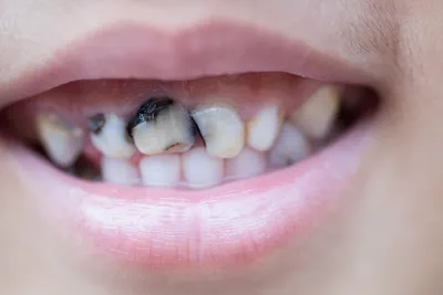 Это же молочные зубы! Зачем их лечить? - YouTube