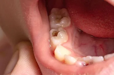 Зачем коронки на молочные зубы? | Сеть стоматологий ПрезиДЕНТ | Дзен