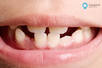 Молочные зубы у взрослых. Что делать? | Как часто такое бывает