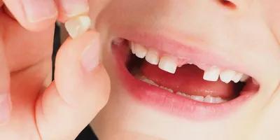 Коронки для молочных зубов: зачем они вообще нужны? Серьёзно? / Хабр