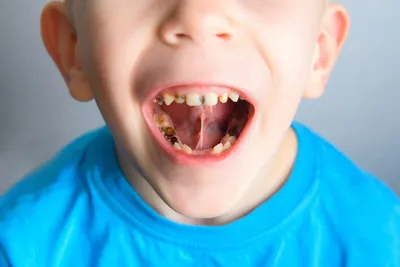 Можно ли ставить брекеты на молочные зубы? :: NORD DENTAL — семейная  стоматология. Две клиники на севере Петербурга