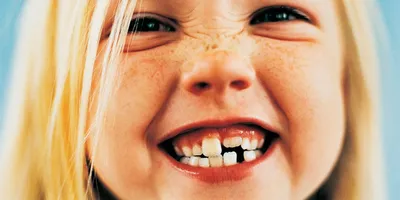 Стоматология Аполлония - Иногда во время физиологической смены зубов  случается такое, что молочные зубы еще не выпали, а постоянные уже начали  прорезываться. ⠀ И в этом случает постоянные прорезаются вторым рядом. Так