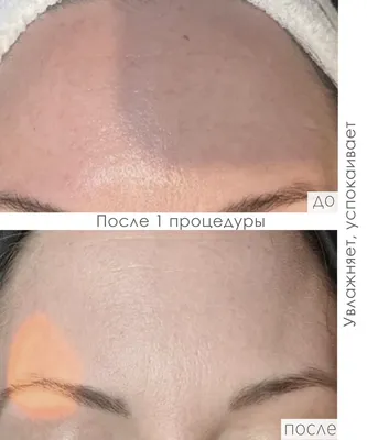 DERMAQUEST » Молочный пилинг с Гиалуроновой кислотой | Самый мощный  увлажняющий пилинг | Отзывы | Купить