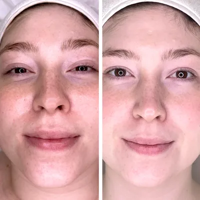 DERMAQUEST » Процедура Молочный пилинг с гиалуроновой кислотой | Самый  мощный увлажняющий | Отзывы | Купить