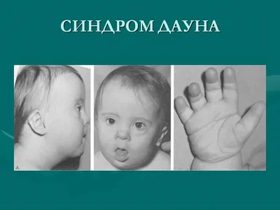 Синдром Дауна — Развивающий Центр | Реутов | Центр гармоничного развития  \"ИМПУЛЬС\"