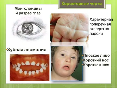 Монголоидный разрез глаз у новорожденного фото фото