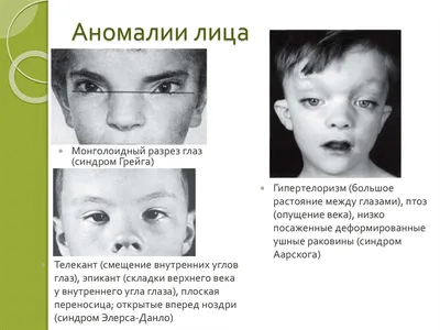 Синдром Дауна — клиника «Добробут»