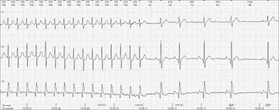 Суточное мониторирование ЭКГ или Холтер мониторинг сердца - Клиника ЮМР