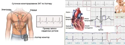 Холтер ЭКГ - мониторинг с расшифровкой в Ростов-на-Дону