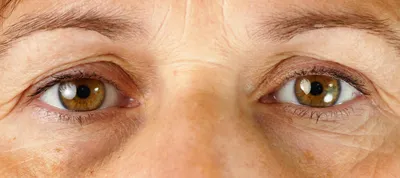 Как убрать морщины под глазами: причины появления, виды, что делать, как  избавиться от морщинок вокруг глаз