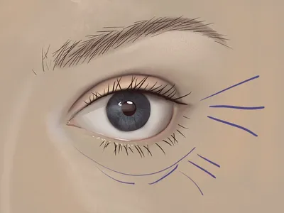 Морщины вокруг глаз: как убрать, причины, профилактика