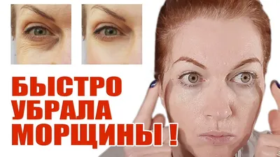 Как убрать морщины под глазами: способы косметологии | Как избавиться от  морщин вокруг глаз у косметолога