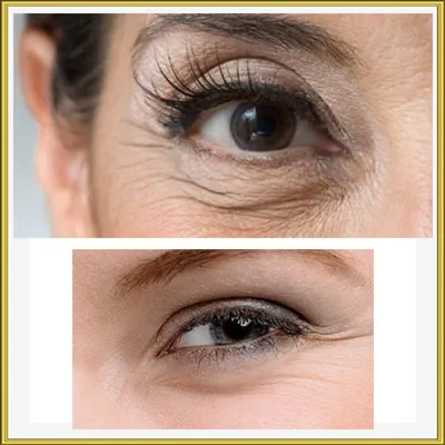 Морщины вокруг глаз - признаки, причины, симптомы, лечение и профилактика -  iDoctor.kz