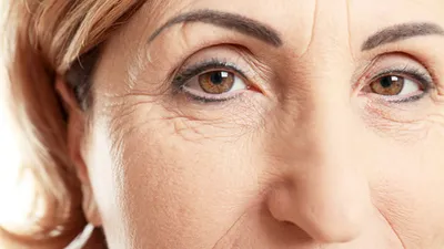Типы морщин на лице: причины появления морщин на лице под глазами и на лбу