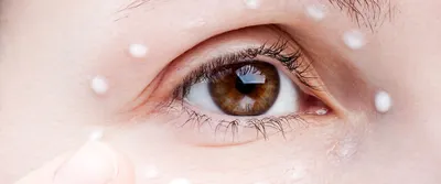 Малярные мешки под глазами: как убрать, причины грыж, как избавиться от  отеков, лечение и удаление в клинике