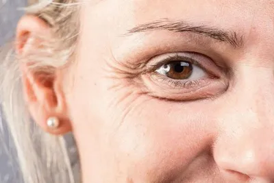 Гусиные лапки вокруг глаз – лечение в медцентре «Номосклиник» | Стоимость  процедуры в Москве, отзывы, вопросы и ответы